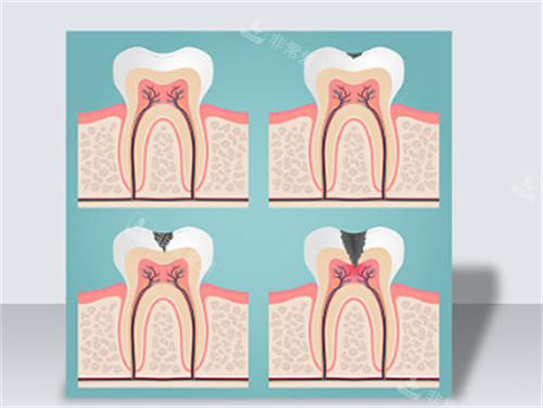 不保护牙齿的危害
