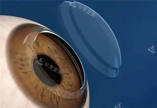角膜塑形镜佩戴图