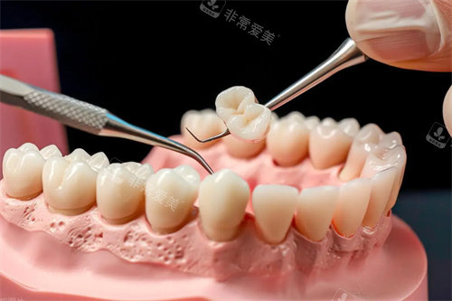 牙齿模型治疗图片