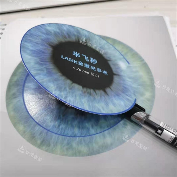 半飞秒Lasik激光手术