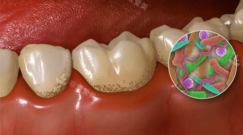 牙齿污垢卡通示意图