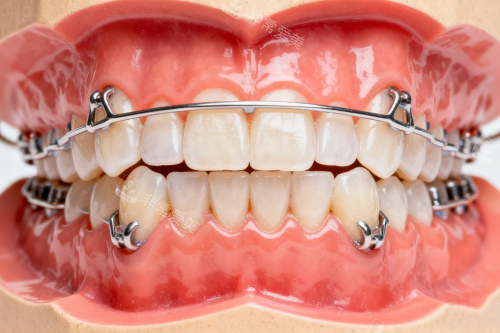 牙齿保持器模型展示图