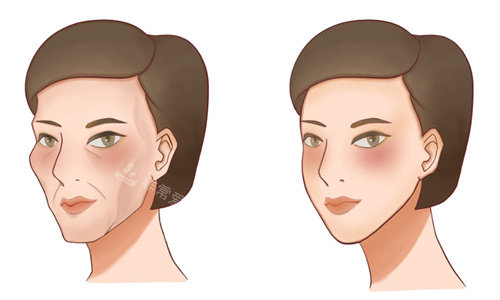 面部填充前后对比卡通