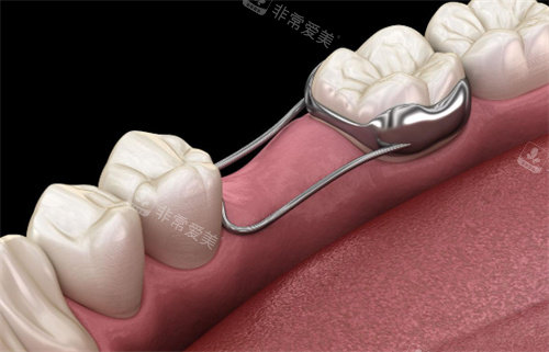 牙齿间隙保持器
