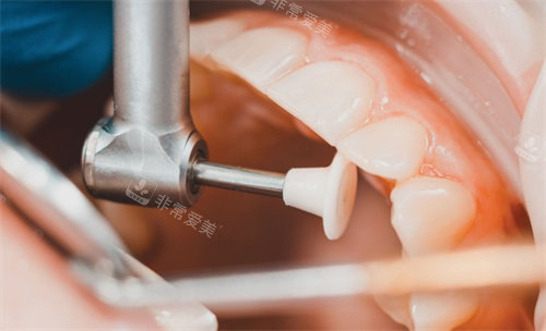 牙齿检查修复操作图