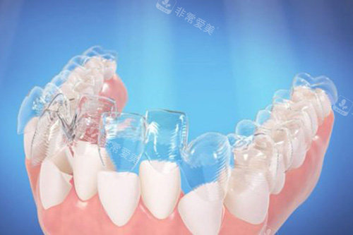 隐形牙套矫正牙齿示意图