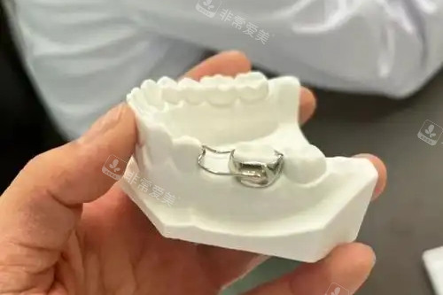 儿童牙齿间隙保持器