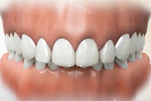 深覆合牙齿示意图