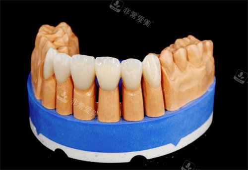 泽康二代全瓷牙