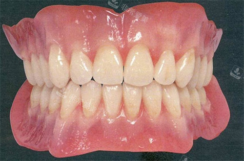 还原真牙的全瓷牙