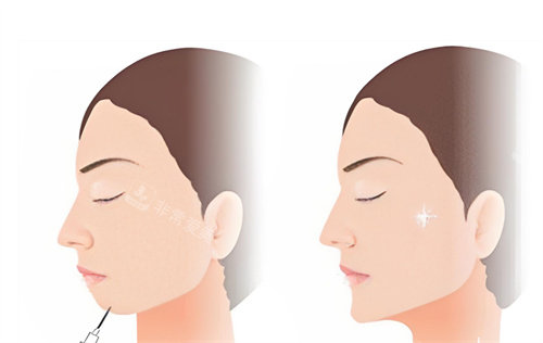 下巴注射前后对比卡通图