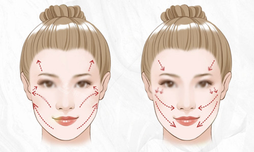 面部轮廓衰老下垂示意图