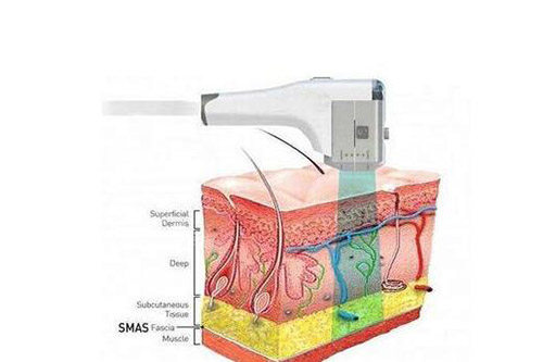 超声炮改善作用展现