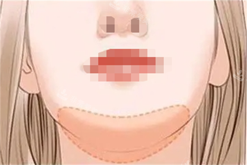 玻尿酸丰下巴部位示意图