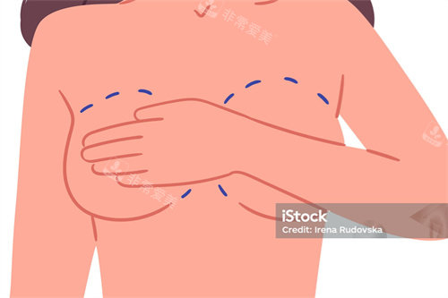 隆胸手术卡通图示