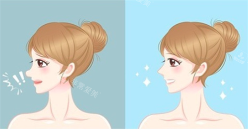 鼻修复对比 鼻修复对比