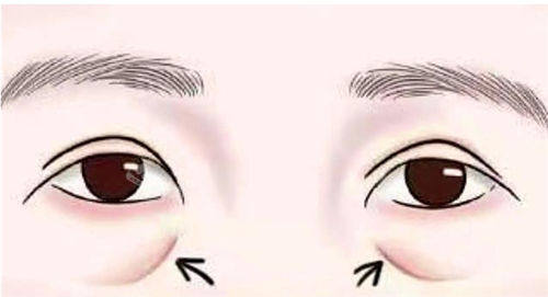 眼部泪沟标注动画展示图