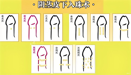 阴茎皮下入珠术