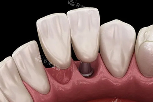 种植牙一拖二内部展示图