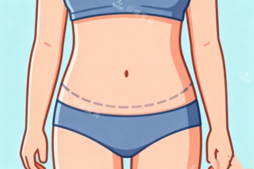 腹部吸脂卡通图一览 腹部吸脂卡通图一览