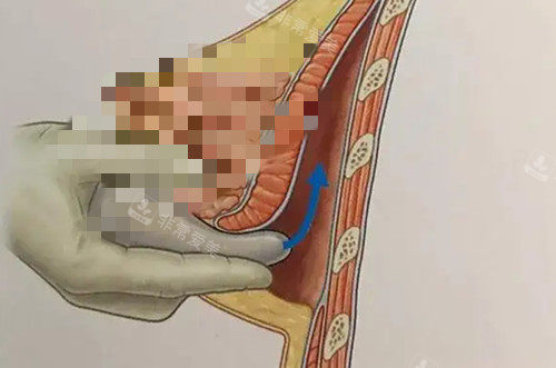 南宁假体隆胸费用大概多少钱？2026全新收费参考|进口vs国产假体，5000-80000起的价差到底在哪？