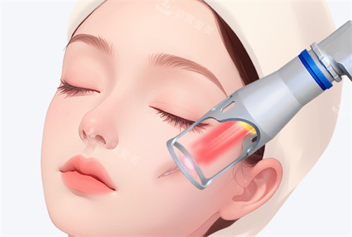 激光去疤怎么样