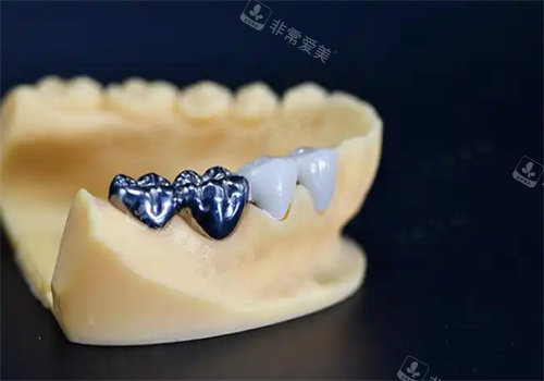 纯钛一体冠牙齿