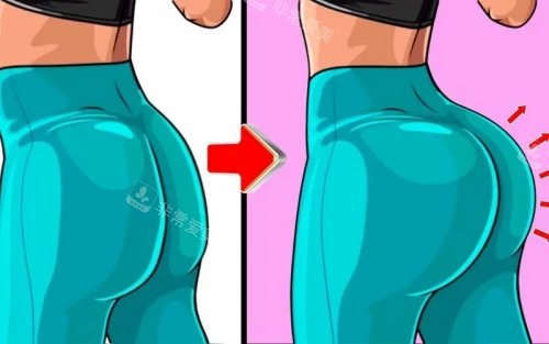臀部填充前后示意图