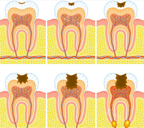 牙齿逐步变蛀牙过程