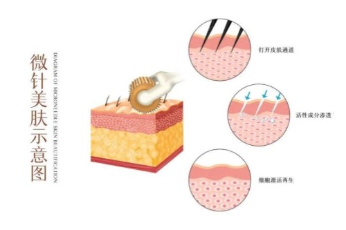 韩国水光焕肤值得做吗？亲身经历告诉你疼痛感、恢复期及效果对比