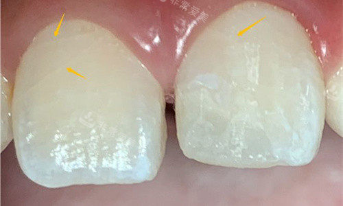 门牙隐裂展示图