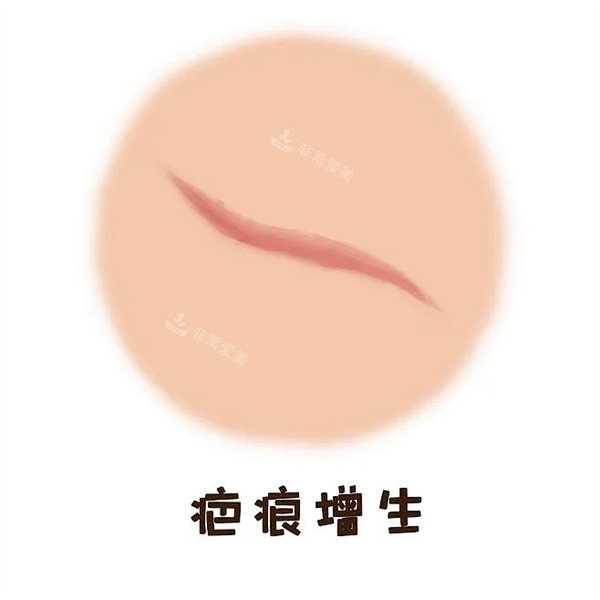疤痕增生图片