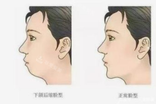 正常脸型和下巴后缩脸型对比图