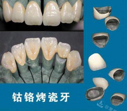 钴铬合金烤瓷牙示意图