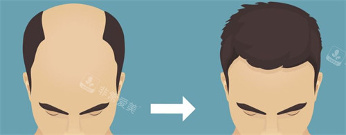 种发际线前后对比
