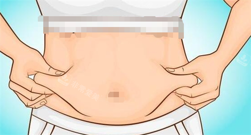 吸脂手术腹部脂肪堆积