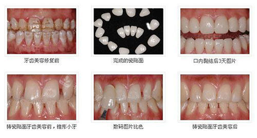 不同方式牙齿美白示意图
