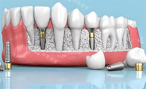 种植牙材料动画展示