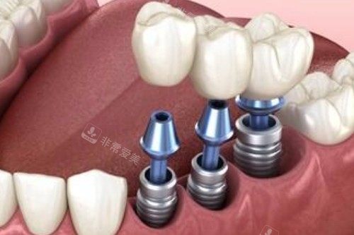 种植牙卡通图展示