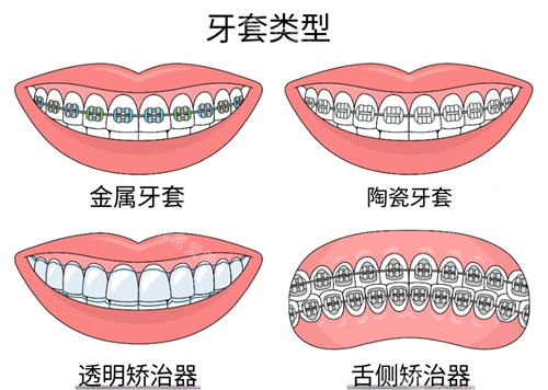 牙齿矫正常见方式