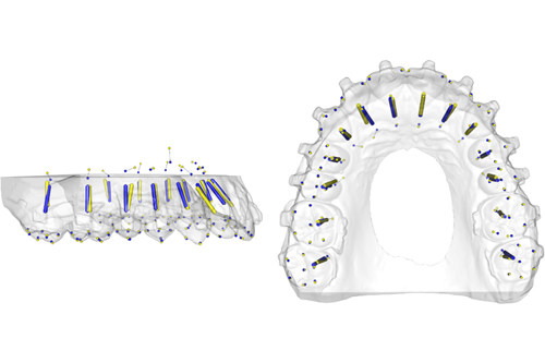 种植牙模拟图像