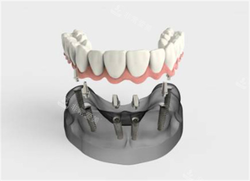 半口种植牙卡通图示意图
