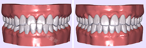 牙齿矫正模拟图前后对比