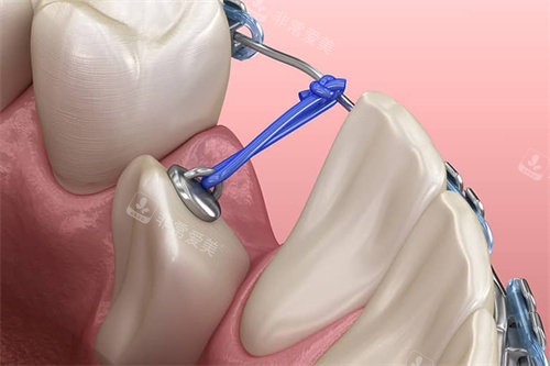 下颌单颗牙齿牵引