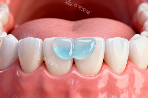 牙齿涂氟卡通图