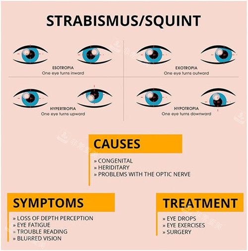 斜视手术介绍图