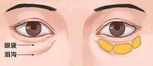 眼周眶隔脂肪位置示意图 眼周眶隔脂肪位置示意图