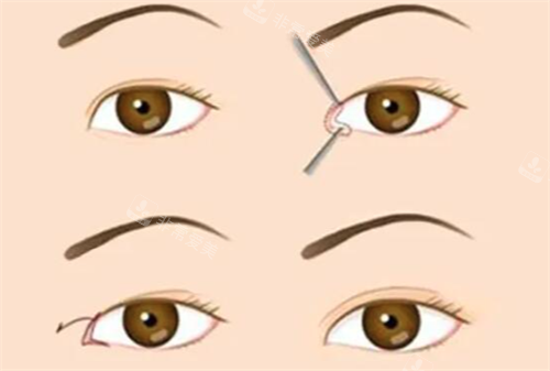 开眼角展示 开眼角展示