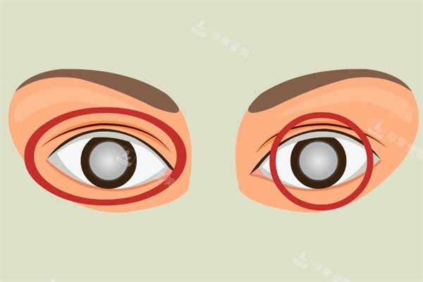 白内障卡通图片展示