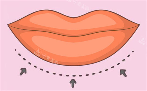 微笑唇套餐是什么？看我花9.9W韩币做玻尿酸+嘴角肉毒的微笑弧度！